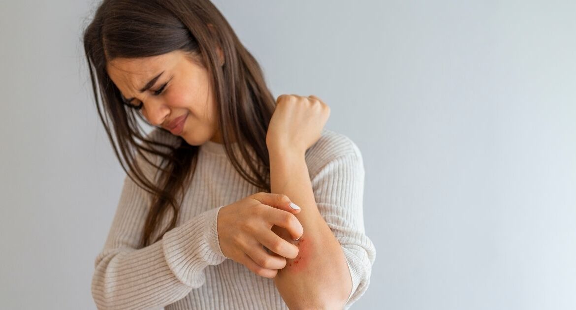 Psoriasi