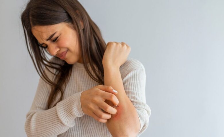 Psoriasi